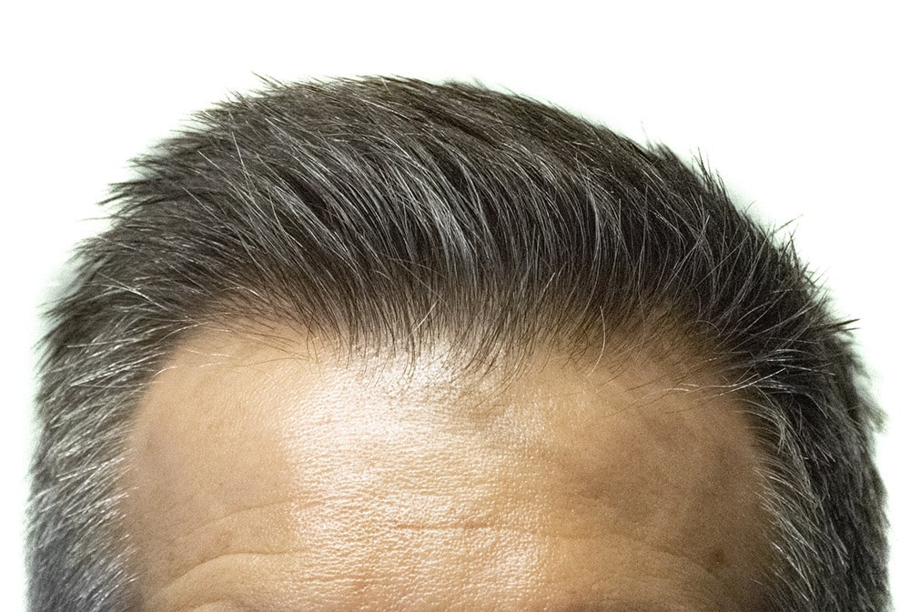 Resultat av hårtransplantasjon i hårlinjen | Medicura