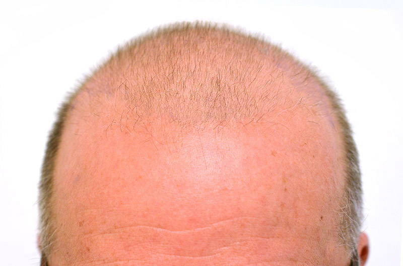Før hårtransplantasjon | Medicura