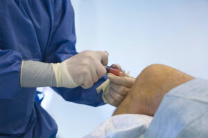 Stamceller i kne mot artrose