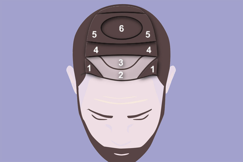 Graftkalkulator for beregning av antall hårsekker man trenger ved en hårtranspalntasjon